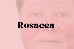 Rosacea Sensitive Skin