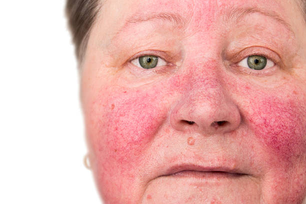 Sensitive Skin Causes Rosacea