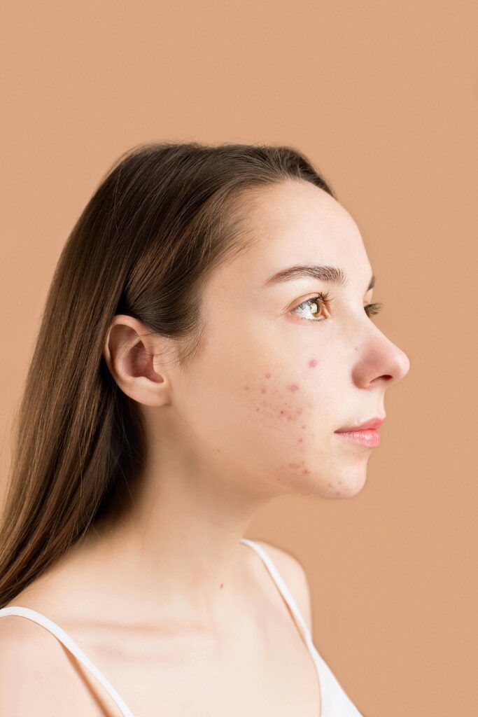 Sensitive Skin Teenage Acne Girl